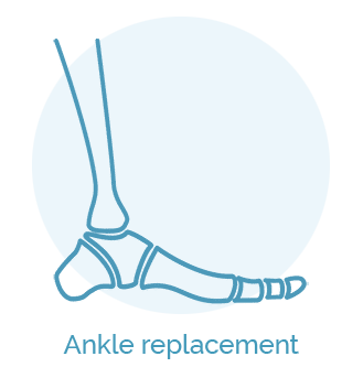Ankle-replacement_su uzrasais 1